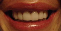 Dental Implants, Crowns – After Picture 