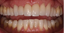 Veneers, Straightening, Bonding – After Picture 