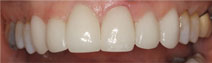 “ Veneers – After Picture 