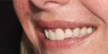 Crowns and Veneers – After Picture