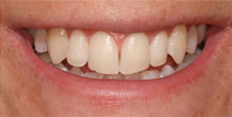 Porcelain Veneers – After Picture