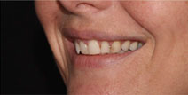 Crowns and Veneers – Before Picture