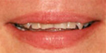 Crowns, Veneers, Bonding – Before Picture