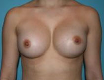Breast Implants – After Picture  - Front
