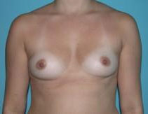 Breast Implants – Before Picture - Front 