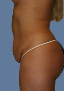 Tummy Tuck – After Picture – Side 