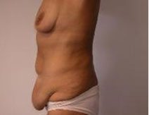 Tummy Tuck – After Picture – Left Side