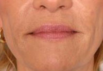 Facial Fillers – After Picture 