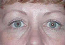 Eye Enhancement – After Picture 