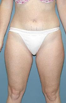 Liposuction – Before Picture – Front 