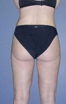  Liposuction – Before Picture – Back