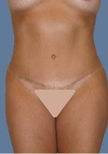 Tummy Tuck – After Picture – Front 